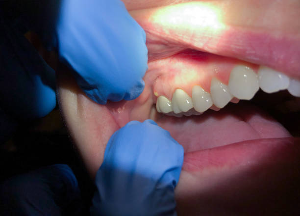 Best Emergency Tooth Extraction in North Crossett, AR